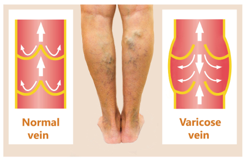 causes an treatment of varicose veins in Tampa