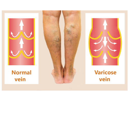 causes an treatment of varicose veins in Tampa