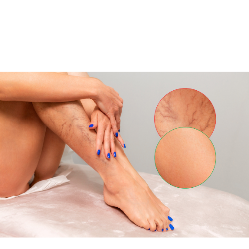 varicose veins treatment in Tampa with Osteopathy